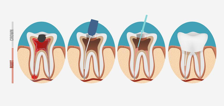 Dantų kanalų gydymas ir plombavimas 2