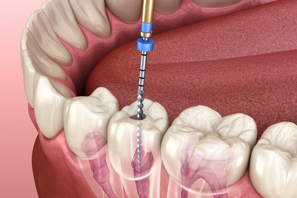 Dantų kanalų gydymas ir plombavimas 1