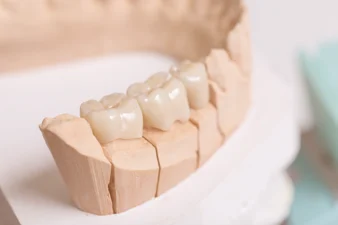 Dantų Protezavimas 4